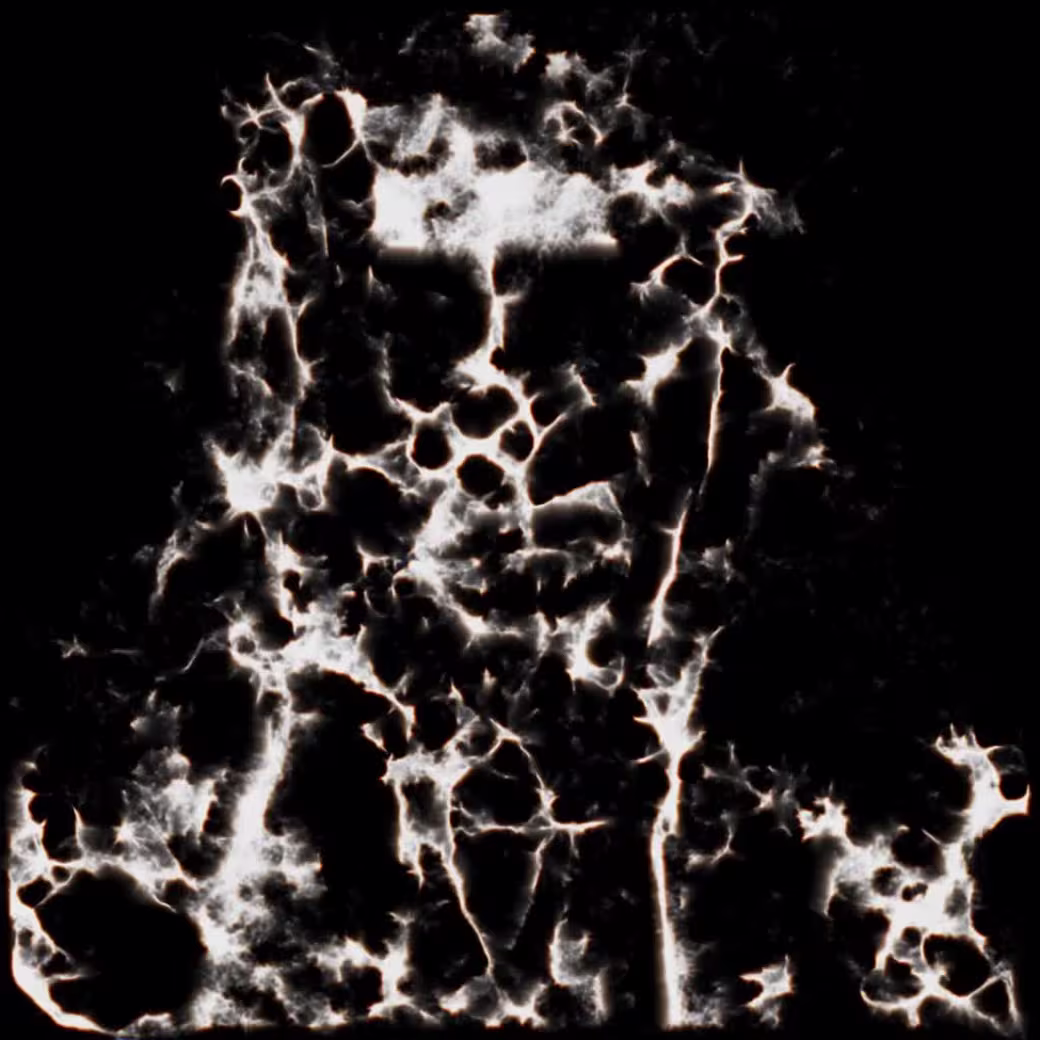Aura Migraine